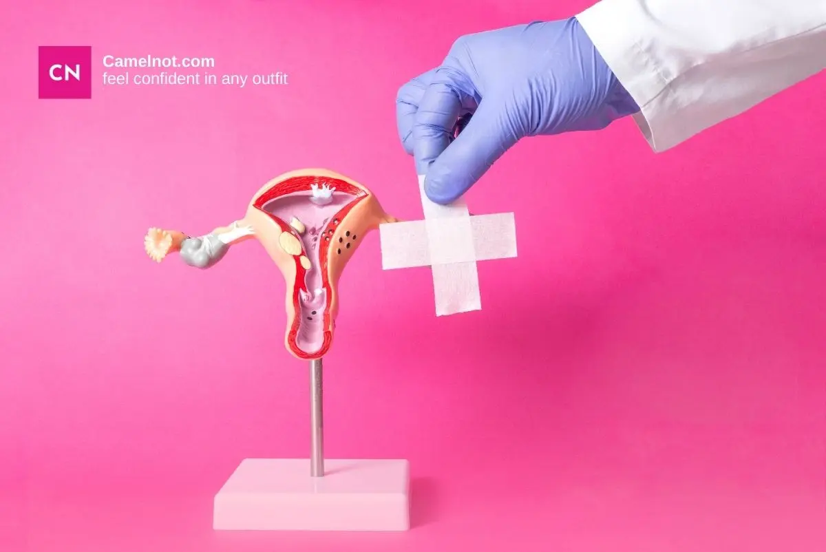 Does Camel Toe Depend on Labia Size?